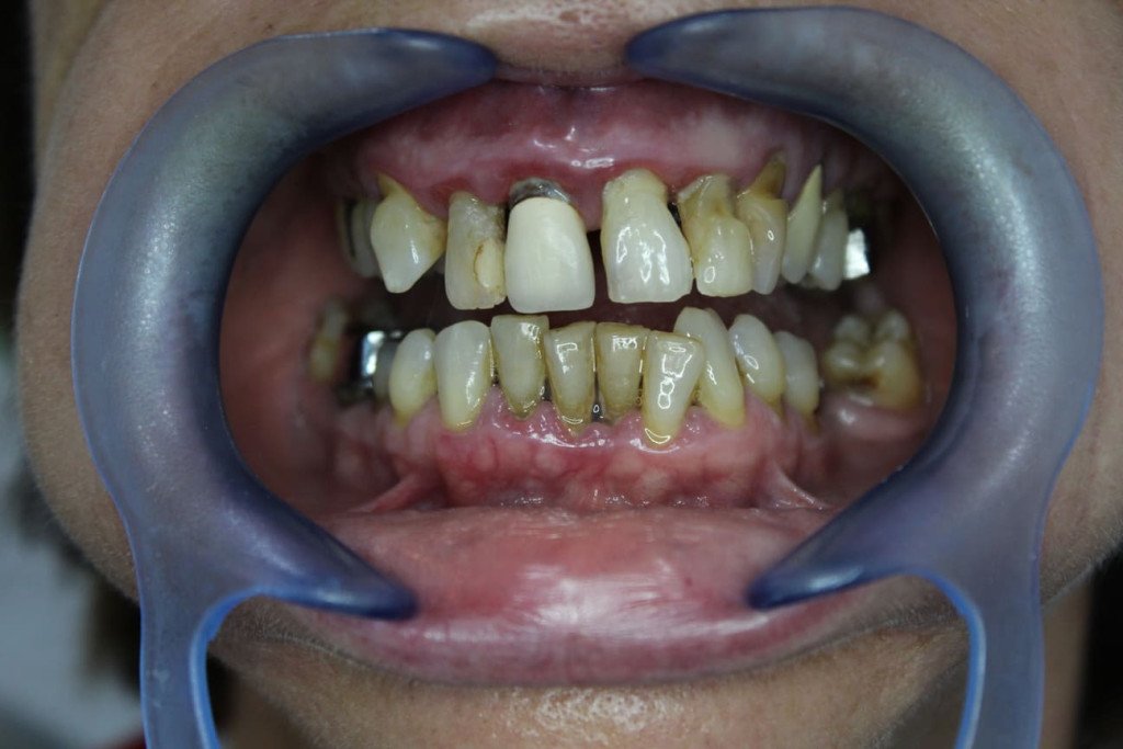 Déchaussement gingival sévère avec gencives enflammées et dents exposées avant traitement