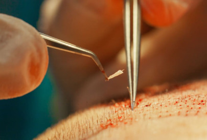 Procédure minutieuse de transplantation de greffons capillaires pour le traitement de la calvitie