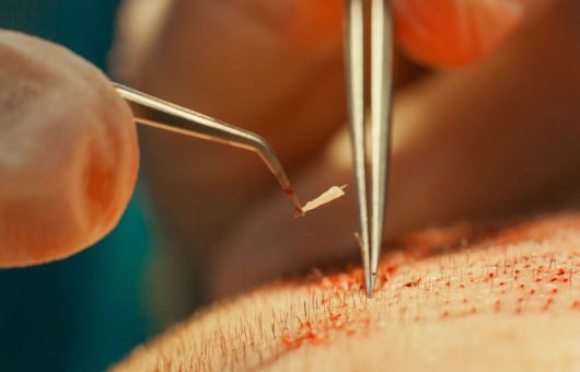 Procédure minutieuse de transplantation de greffons capillaires pour le traitement de la calvitie