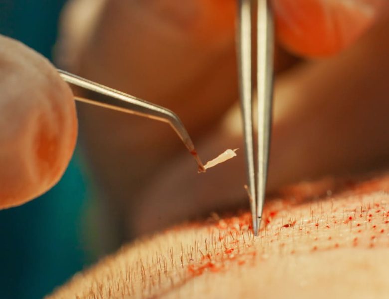 Procédure minutieuse de transplantation de greffons capillaires pour le traitement de la calvitie