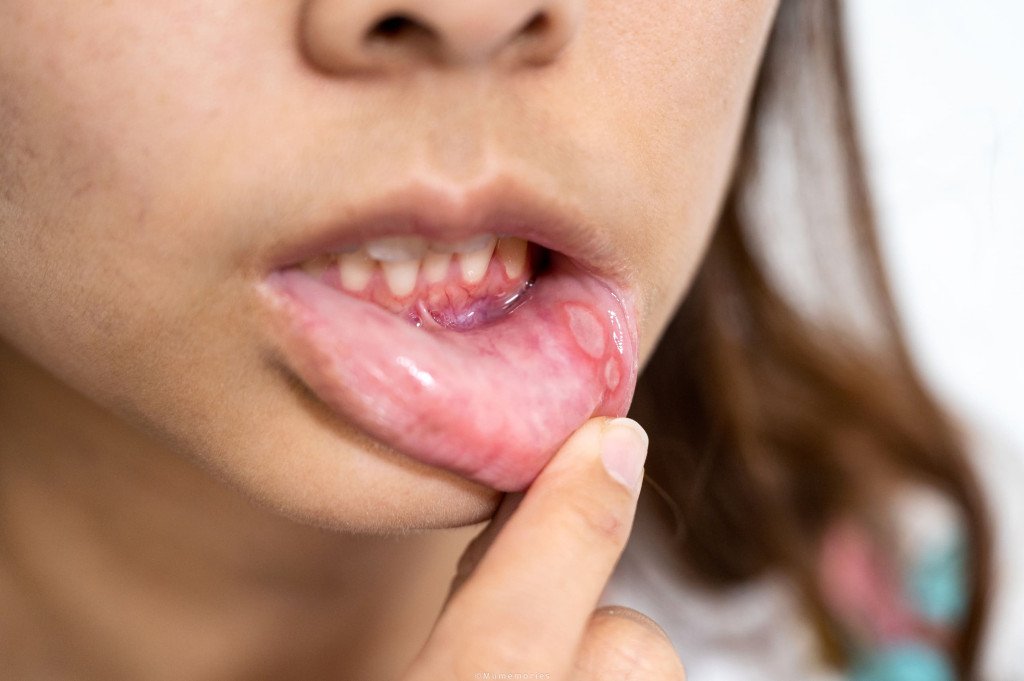 Un enfant pointant du doigt une lésion ou une inflammation sur la gencive inférieure, ce qui peut indiquer une infection buccale.