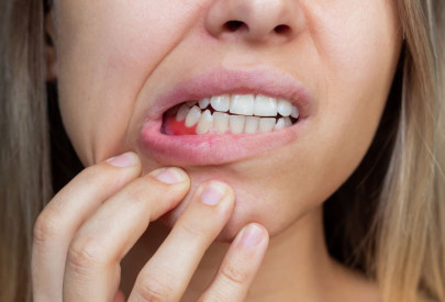 Femme montrant une douleur ou une lésion sur sa gencive inférieure, suggérant une urgence dentaire ou une inflammation des gencives.