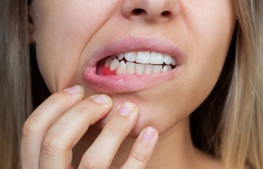 Femme montrant une douleur ou une lésion sur sa gencive inférieure, suggérant une urgence dentaire ou une inflammation des gencives.