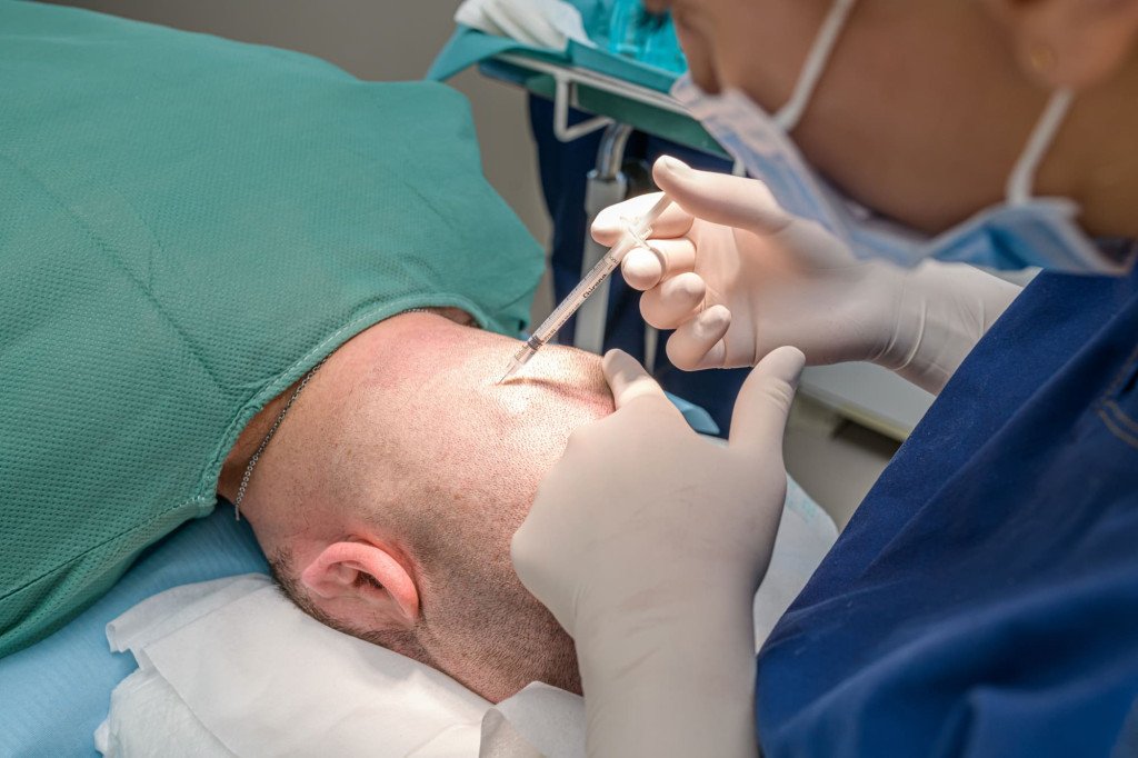 Procédure d'anesthésie locale lors d'une greffe de cheveux, avec un patient endormi et un médecin appliquant l'anesthésique.