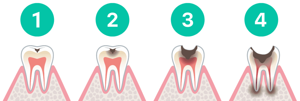 Illustration des quatre étapes de la progression de la carie dentaire.