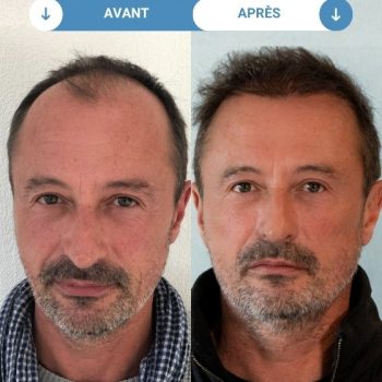 nicolas avant et apres greffe de cheveux
