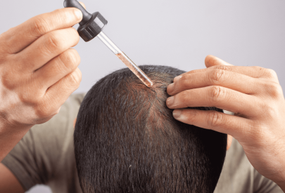 Un homme applique du Minoxidil sur son cuir chevelu, illustrant un traitement contre la perte de cheveux.