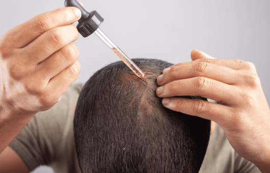 Un homme applique du Minoxidil sur son cuir chevelu, illustrant un traitement contre la perte de cheveux.