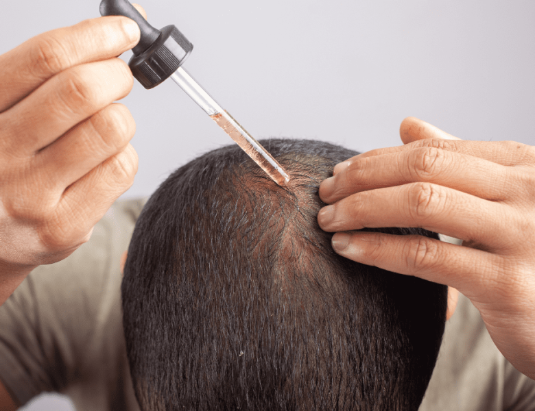 Un homme applique du Minoxidil sur son cuir chevelu, illustrant un traitement contre la perte de cheveux.