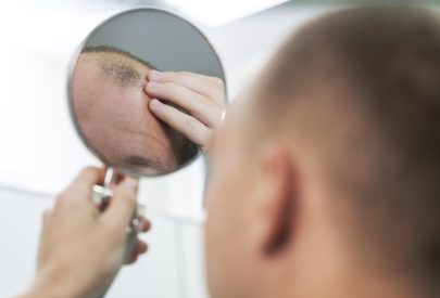 Homme qui a des problèmes de calvitie et pense à une solution de greffe de cheveux