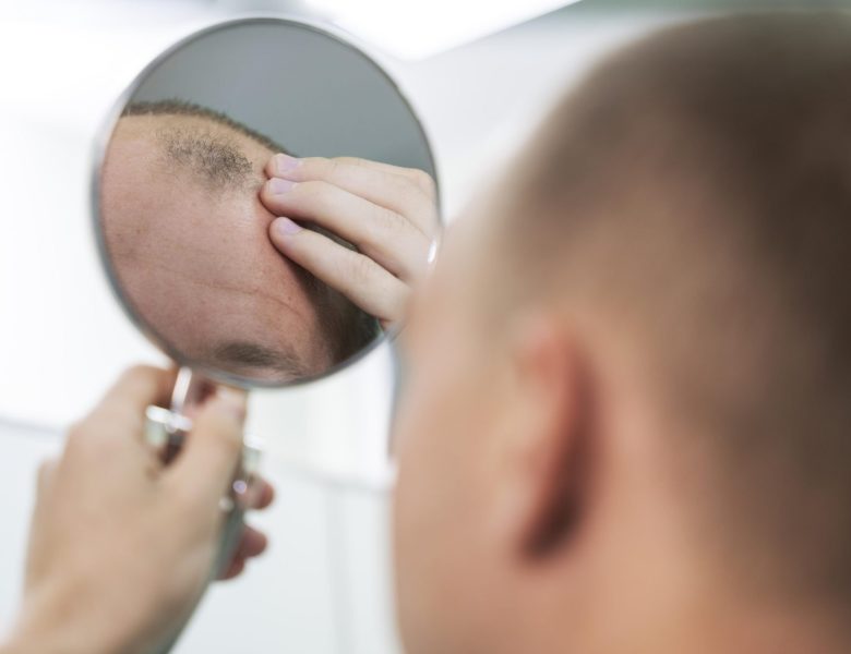 Homme qui a des problèmes de calvitie et pense à une solution de greffe de cheveux