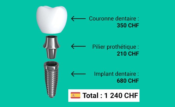 Coût d'un implant dentaire complet, en fonction de chacun de ses composants