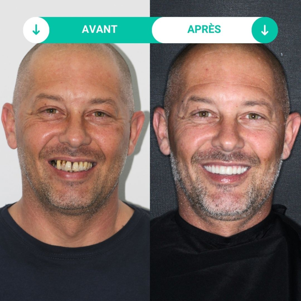 avant après julien