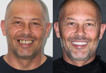 avant après julien