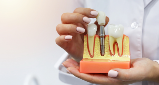 illustration d'un implant, entre deux dents saines