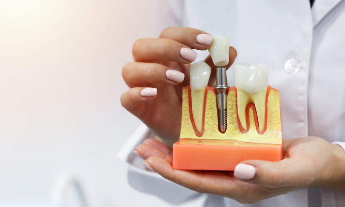 illustration d'un implant, entre deux dents saines