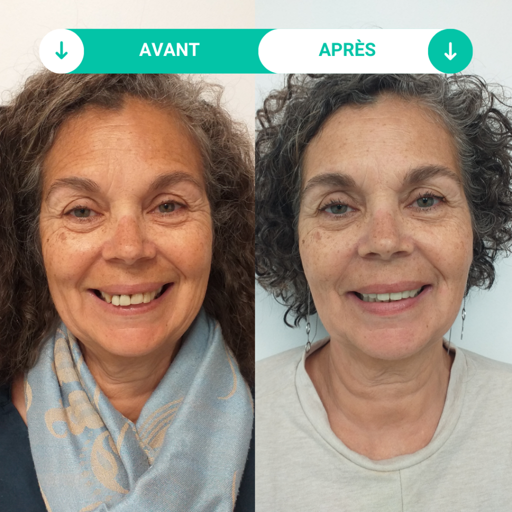 photos avant et après des soins dentaires