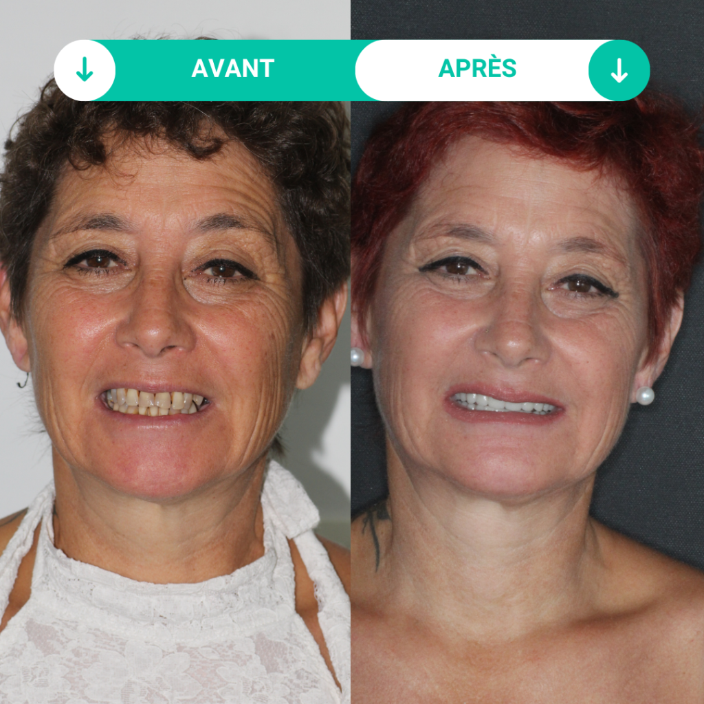 photos avant et après des soins dentaires