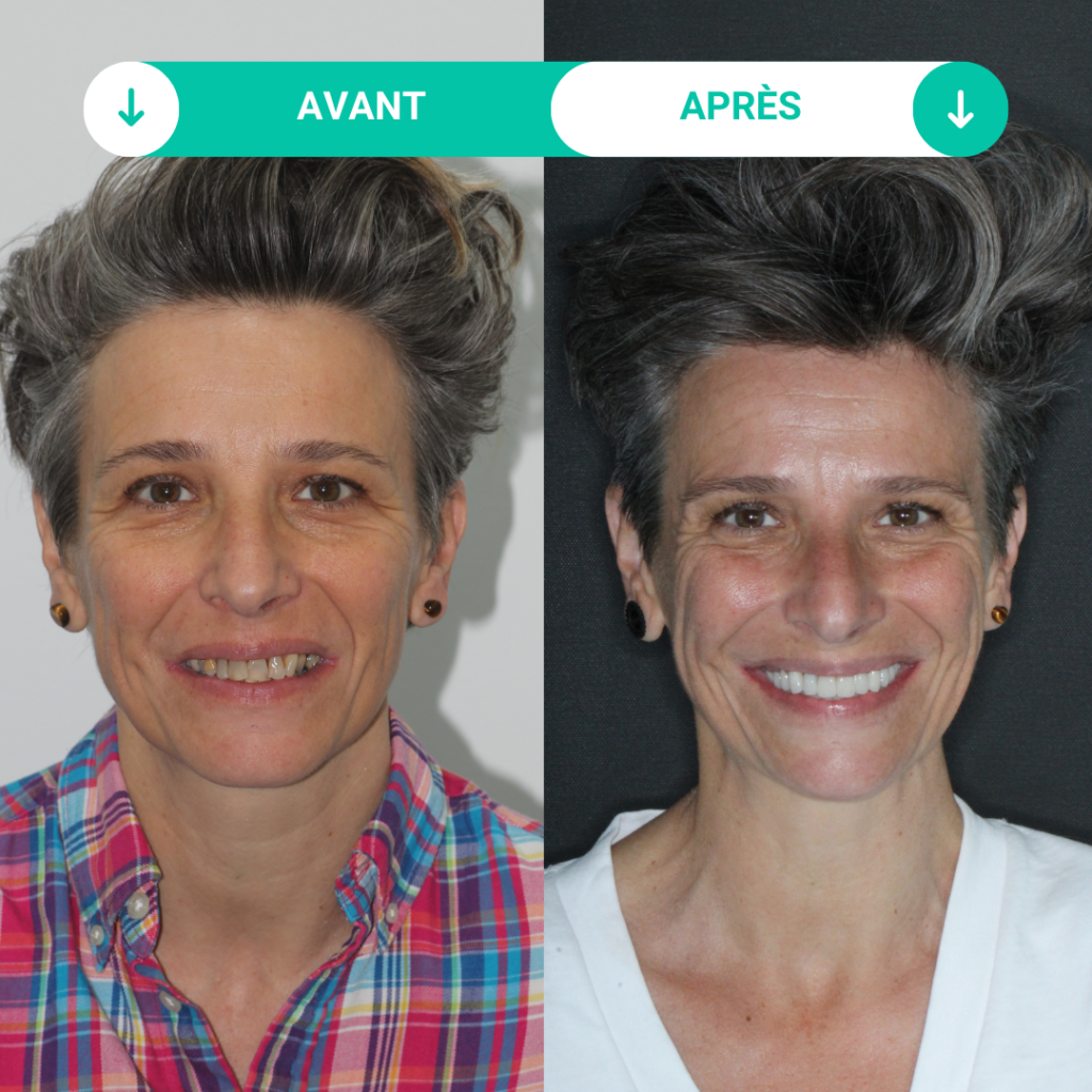photos avant et après des soins dentaires
