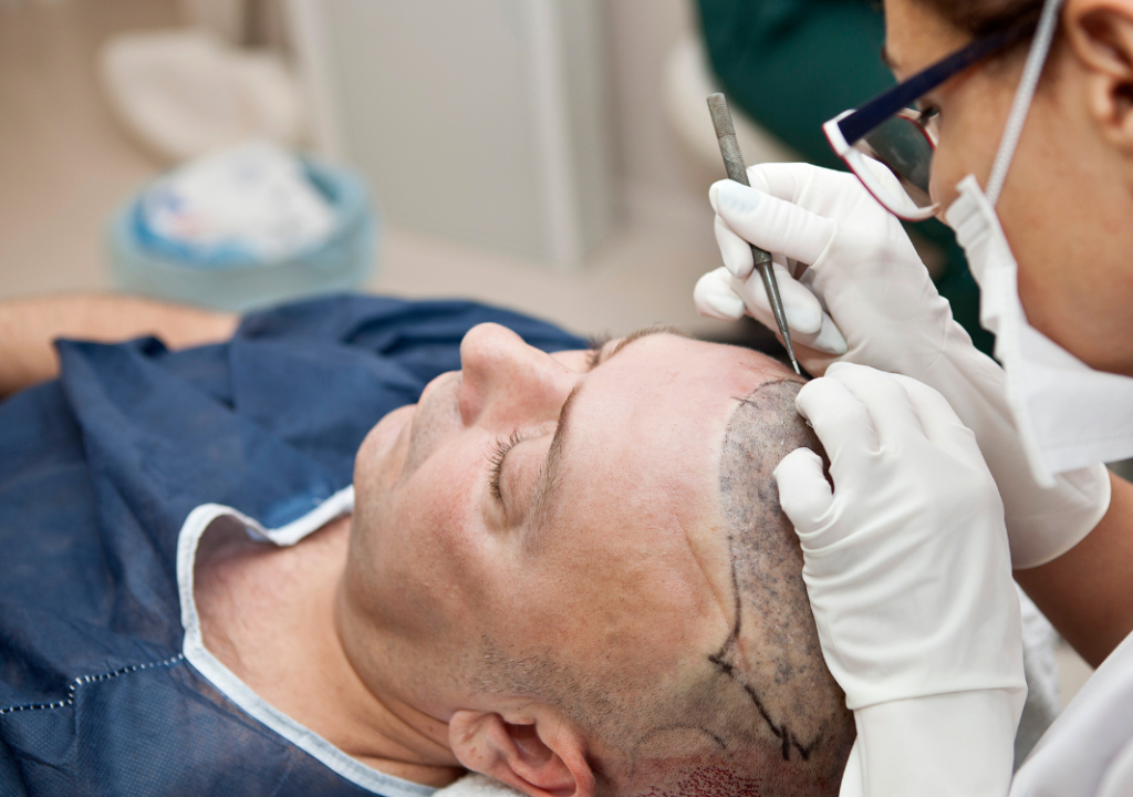 homme qui se fait une greffe de cheveux sous anesthesie locale