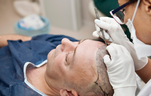 homme qui se fait une greffe de cheveux sous anesthesie locale
