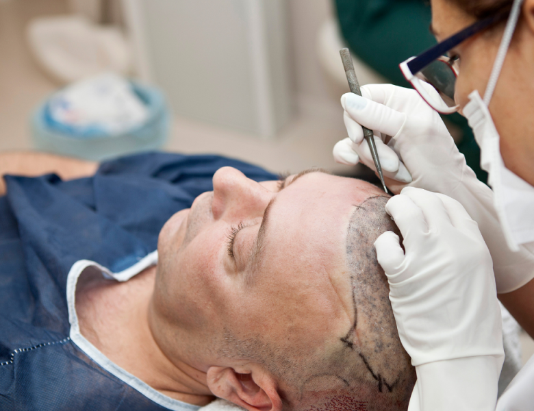 homme qui se fait une greffe de cheveux sous anesthesie locale