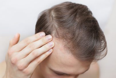 Greffe de cheveux homme sur cheveux fins