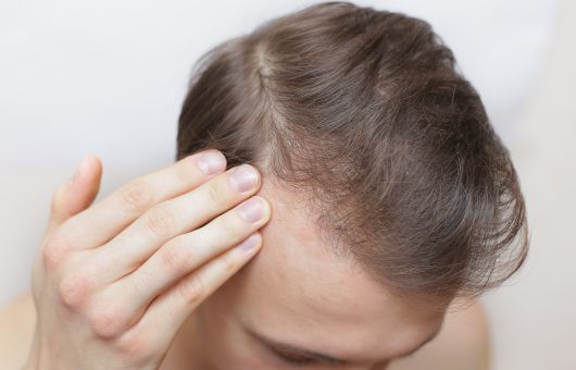 Greffe de cheveux homme sur cheveux fins