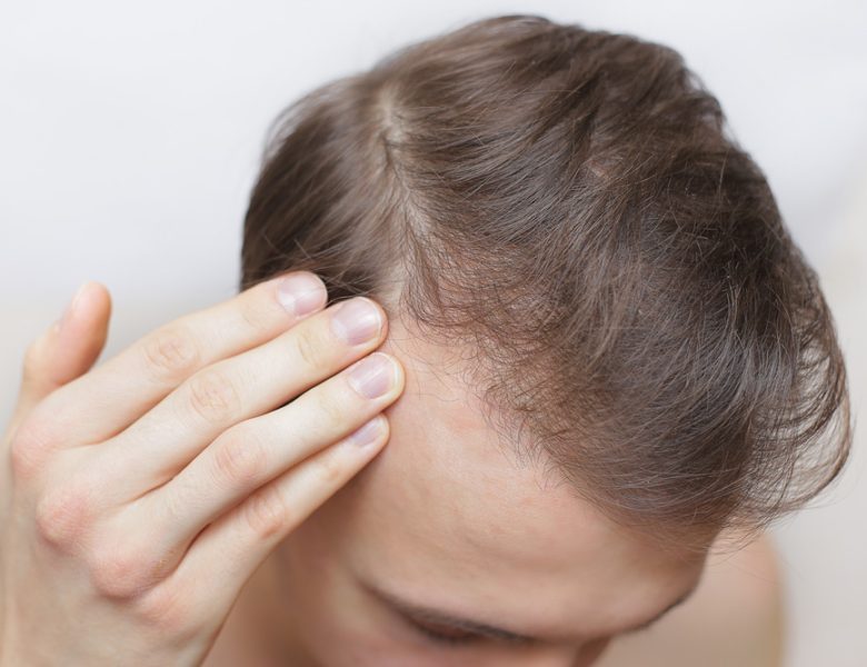 Greffe de cheveux homme sur cheveux fins