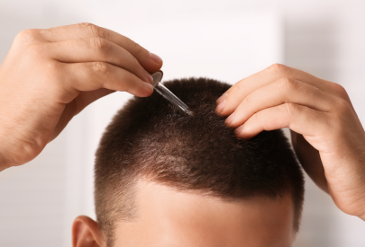 Application du minoxidil 5
