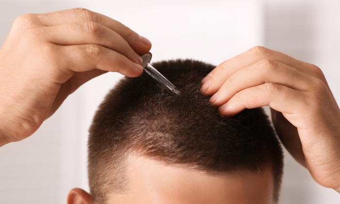 Application du minoxidil 5