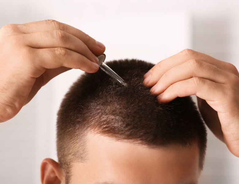 Application du minoxidil 5