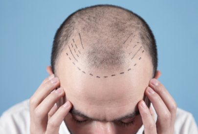 homme qui vient de faire une greffe de cheveux
