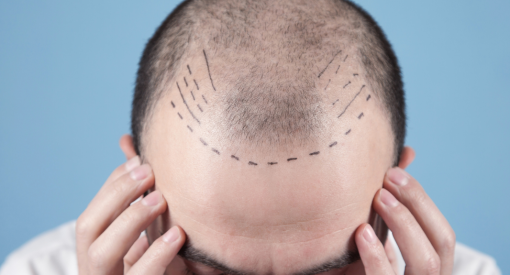homme qui vient de faire une greffe de cheveux