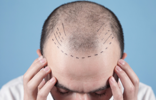homme qui vient de faire une greffe de cheveux