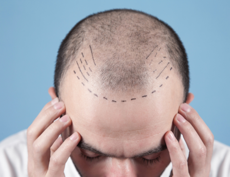 homme qui vient de faire une greffe de cheveux