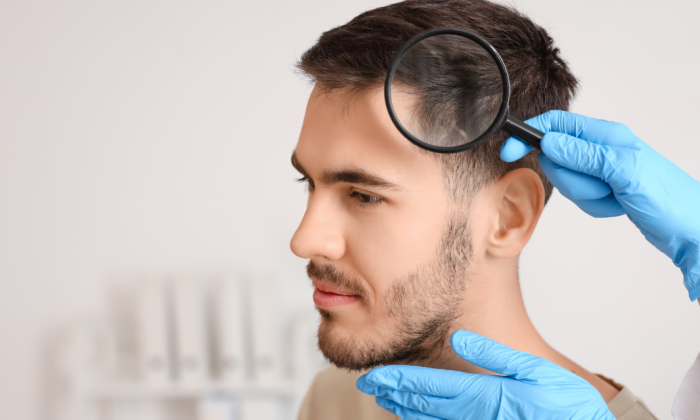 greffe de cheveux pour homme