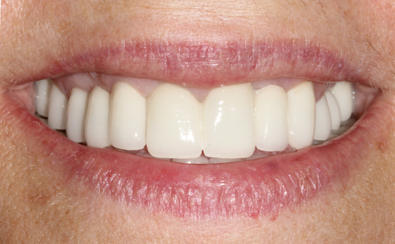 sourire apres soins dentaires morel