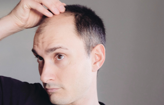 homme qui observe sa perte de cheveux sur les golfes