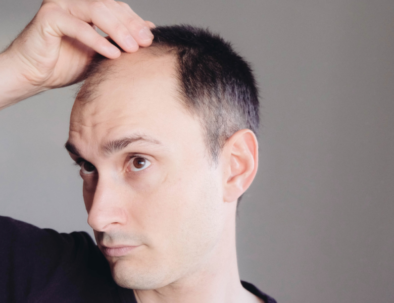 homme qui observe sa perte de cheveux sur les golfes