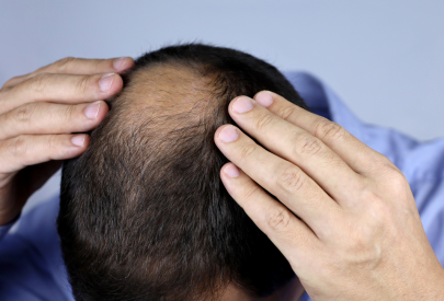 homme avec un dégarnissement des cheveux à la tonsure