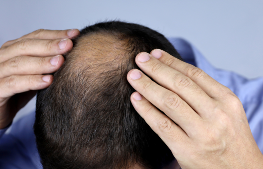 homme avec un dégarnissement des cheveux à la tonsure