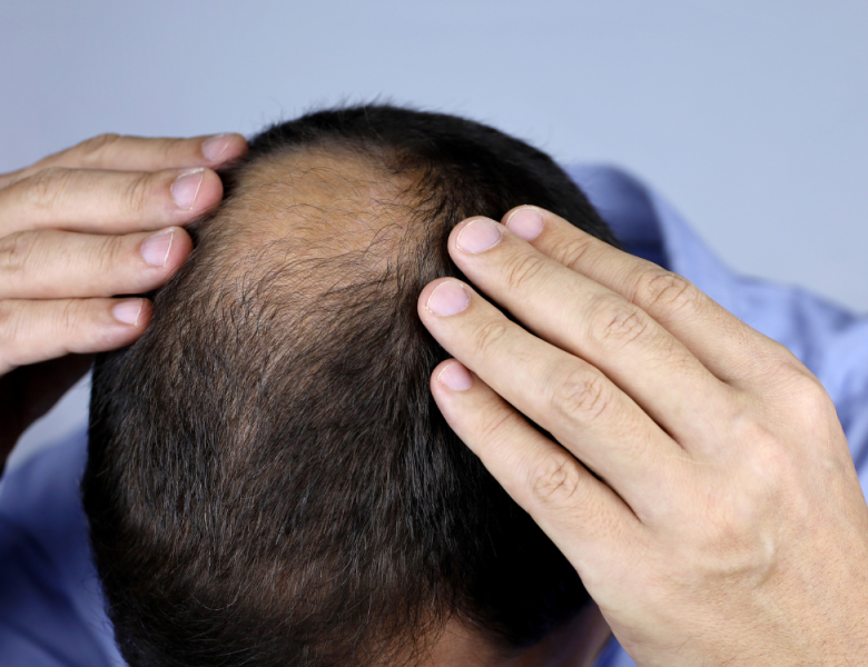 homme avec un dégarnissement des cheveux à la tonsure