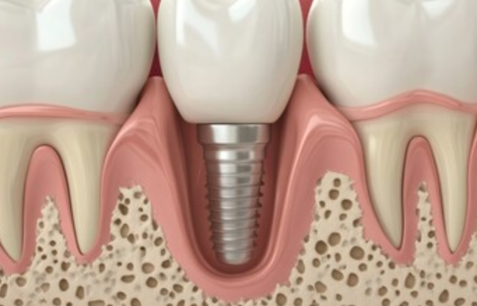 illustration de la cicatrisation osseuse d'un implant