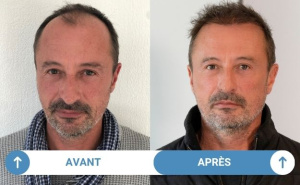 avant après nicolas