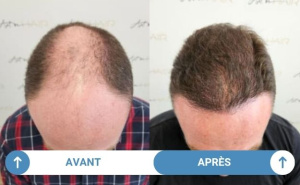 avant après jean-michel