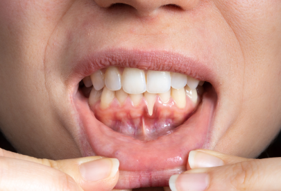 dents qui se déchaussent