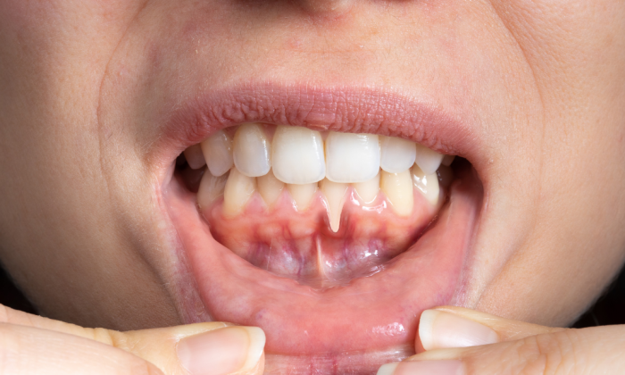 dents qui se déchaussent