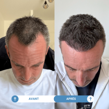 Etude de cas de Julien ayant réalisé une greffe de cheveux avec Smile Partner