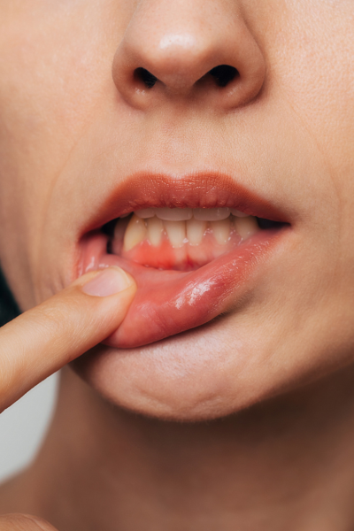 femme ayant les gencives rouges et douloureuses
